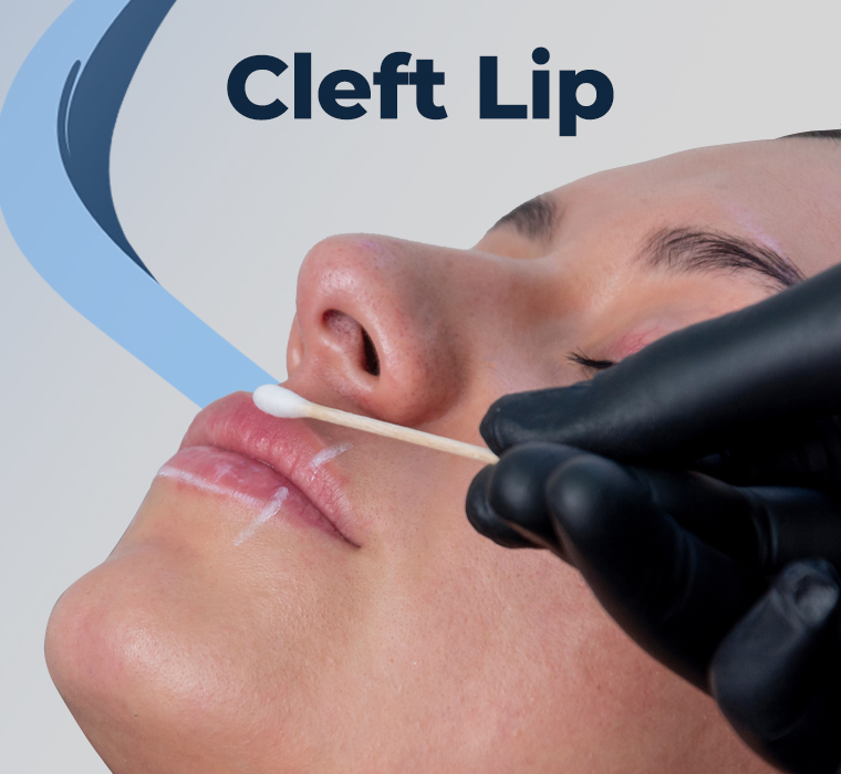 Cleft Lip